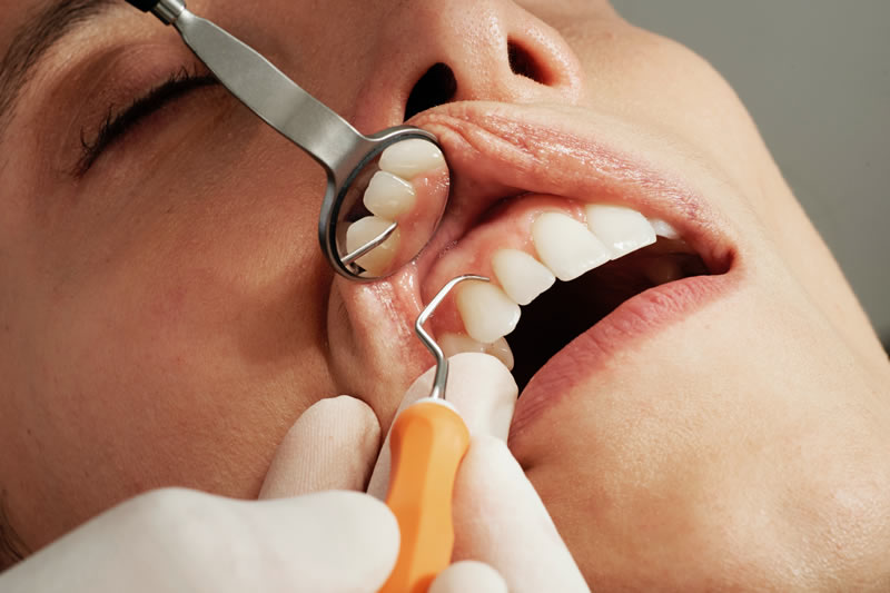 Kontrolle Zähne mit Spiegel und Füllungsinstrument
